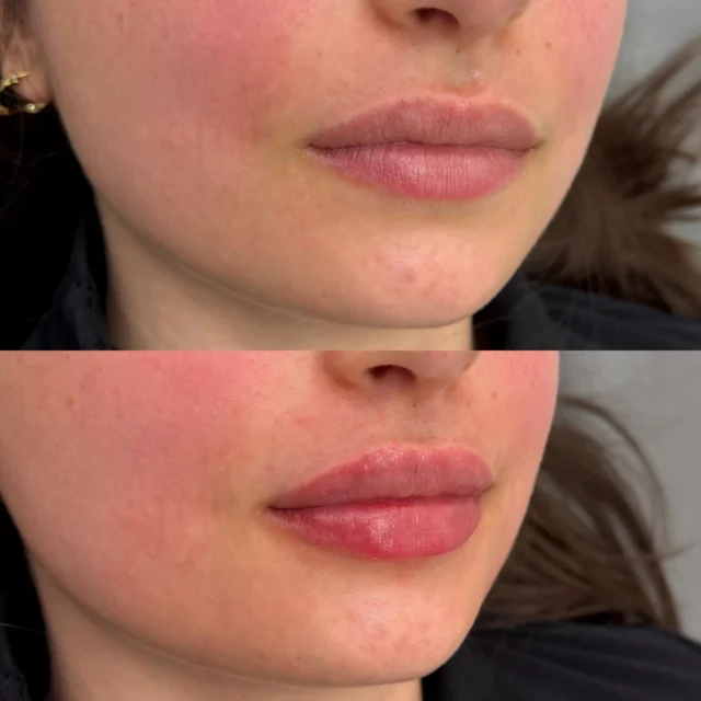 hikari glutathione fda approved philippines HIKARI DRIP Give your skin what it truly needs with Hikari Drip, a  powerful infusion of glow-enhancing nutrients that hydrate the body, reduce  fatigue, and leave you looking effortlessly fresh and radiant.