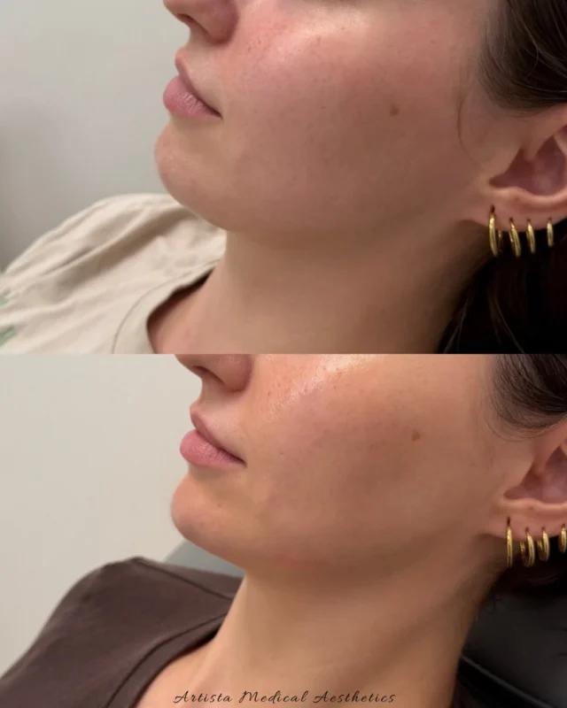 glutathione iv hamilton Dull, tired-looking skin and uneven tone? Injection helps brighten and refresh your skin from within for a clearer and more radiant complexion  Known for its powerful antioxidant properties, Glutathione helps IV Therapy & Vitamin Shots